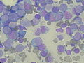 Mieloblasti u akutnoj mieloidnoj leukemiji