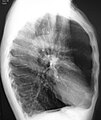 Radiografia laterale del torace di una persona con enfisema. Si notino il torace a botte e il diaframma piatto.
