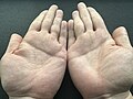 Bilateral single transverse palmar crease. The single transverse palmar crease is present on both hands of the individual.