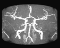 Poligono di Willis, immagine di risonanza magnetica, sequenze angiografiche, proiezione anteriore.