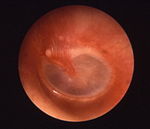 trumhinna med tecken på begynnande öroninflammation (framträdande blodkärl)