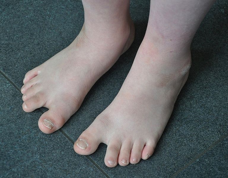 File:Feet of a boy with Down Syndrome.JPG