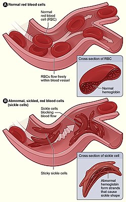 На верхньому зображені показано нормальні еритроцити, що проходять по венах без утруднень. На нижньому зображенні серпоподібні еритроцити, вони застрягають і накопичуються у місцях розгалуження вен